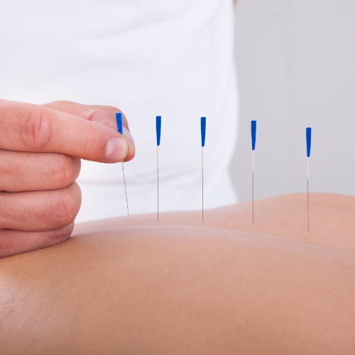 Trigger-point-dry-needling-coast-rehab-millstone-manasquan-toms-river-nj